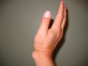 ganlion cyst2.jpg