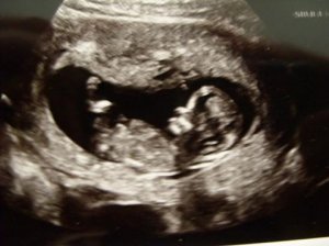 12w2d NT scan.jpg