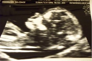 Aidan 12 weeks NT scan.JPG