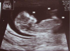 Copy of 11 weeks 5 days closeup with labels.JPG