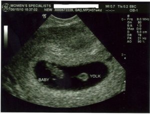 7w4d ultrasound[1][1].jpg