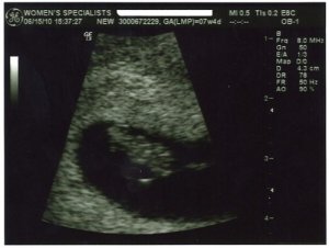 7w4d ultrasound zoom[1][1].jpg
