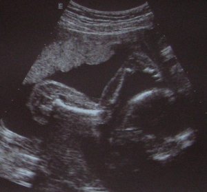 Baby 21w6d with knee and foot beside head.JPG