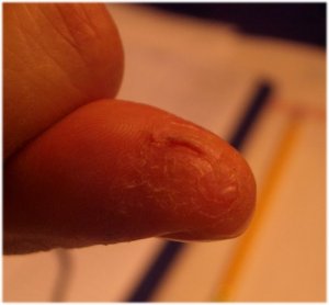 IMGP7808eczema1.JPG