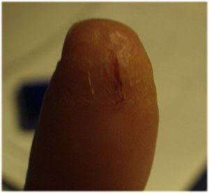 IMGP7809eczema2.JPG
