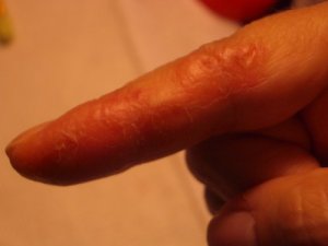 IMGP7812eczema3.JPG