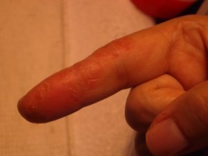 IMGP7813eczema4.JPG