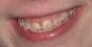 bracespinkdee.JPG