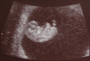 9w4d ultrasound.JPG