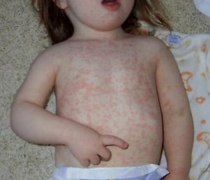measles.jpg