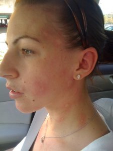 cdub allergic reaction.jpg cdub allergic reaction.jpg