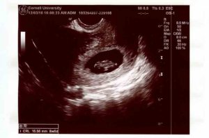 12-3-10-ultrasound-pic1-no-.jpg