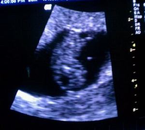 Baby8w4dUltrasound.png