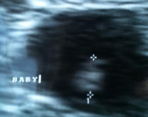 si_cycle1_ultrasound1.JPG