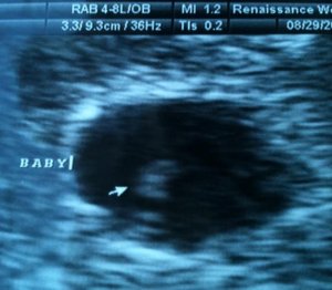 si_cycle1_ultrasound2.JPG