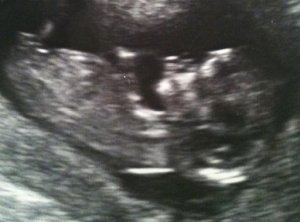 si_cycle1_ultrasound3.JPG