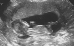 Second ultrasound1321321 - Copy.jpg