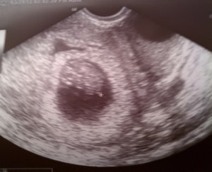 8 wks 6 days ultrasound.jpg
