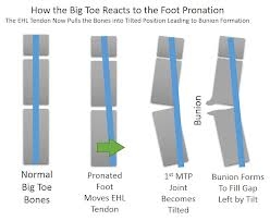 bunion.jpg