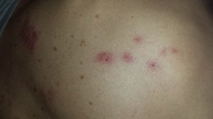 spiderbites.jpg