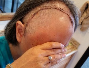 cheryls_craniotomy_2015_103_small.jpg cheryls_craniotomy_2015_103_small.jpg