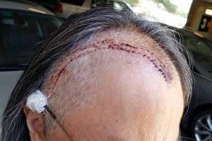 cheryls_craniotomy_2015_109_small.jpg cheryls_craniotomy_2015_109_small.jpg