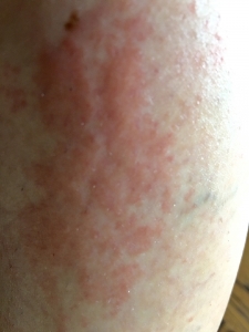 rashlowerleftleg10-09-16-10-26.jpg rashlowerleftleg10-09-16-10-26.jpg