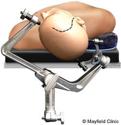 PE-Craniotomy_Figure2.jpg