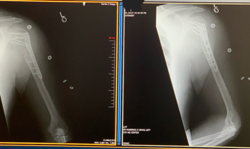 brokenshoulderjoe.png
