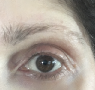 eyebrowalopecia.png eyebrowalopecia.png
